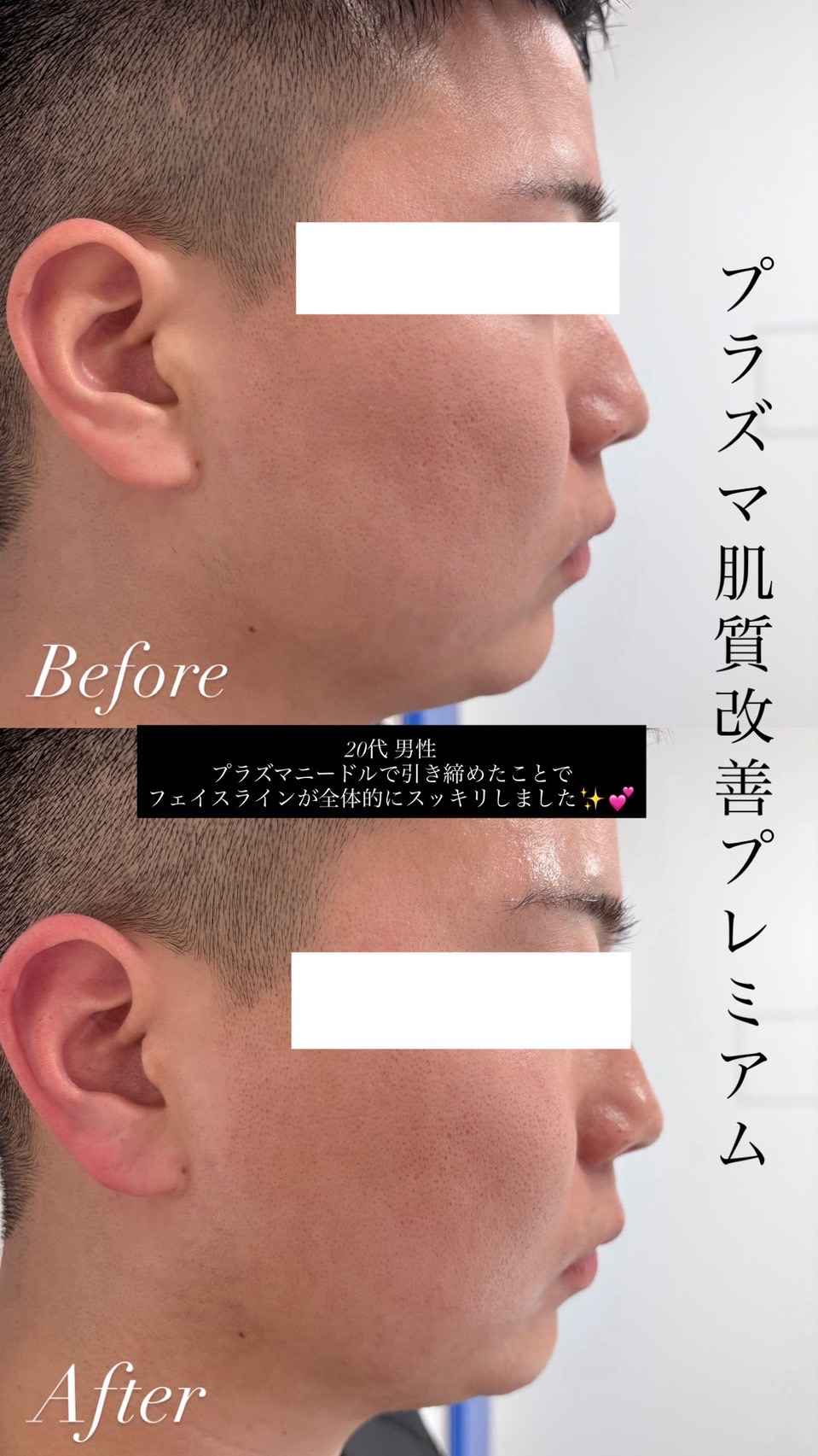プラズマニードル 20代男性 フェイスラインがすっきりしたビフォーアフター