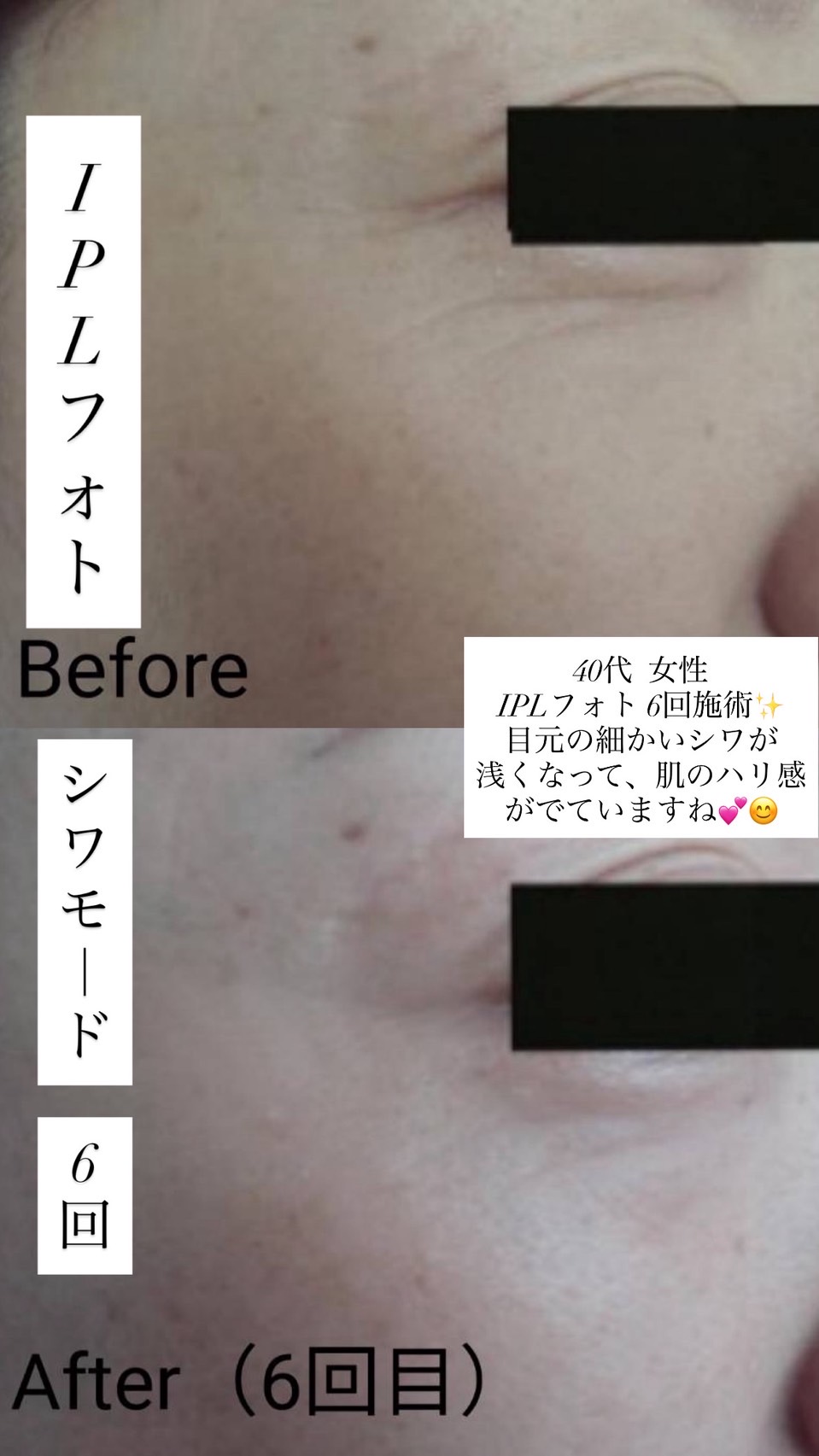 IPLフォトフェイシャル改善事例 40代女性 シワモード 目元の細かいシワ ハリ感 6回目のビフォーアフター