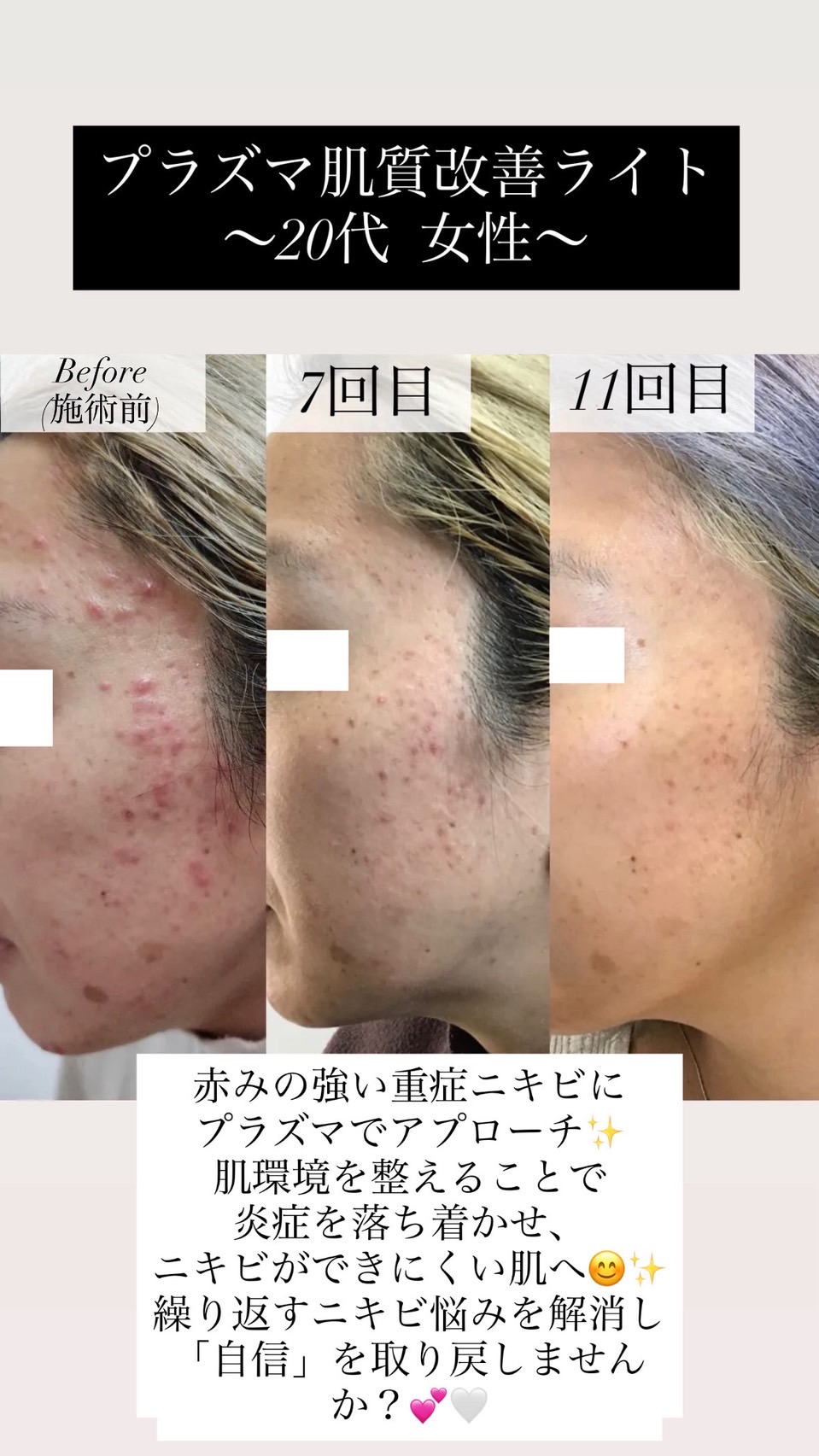 プラズマ肌質改善ライト 20代女性 重症ニキビ 赤み 肌荒れの経過症例