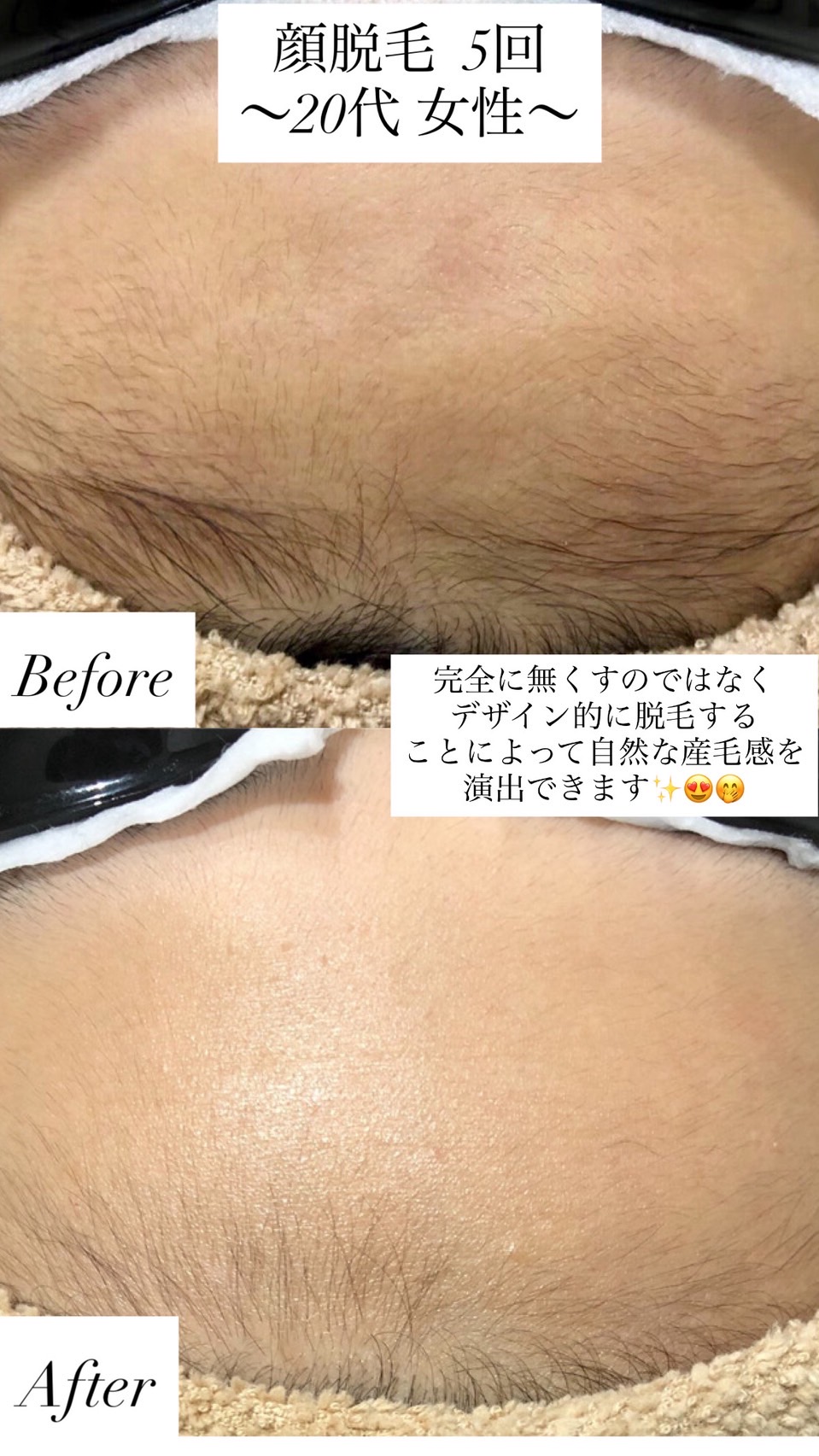 女性 顔脱毛 5回目のビフォーアフター