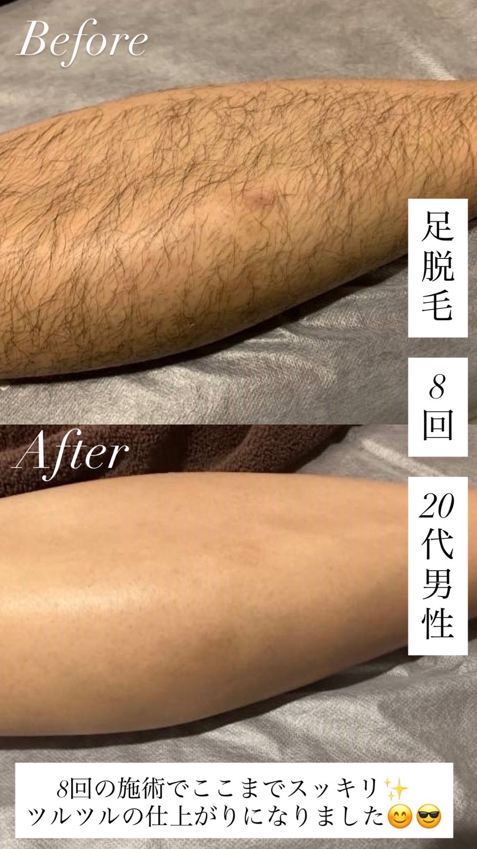 男性 脚脱毛 8回目のビフォーアフター