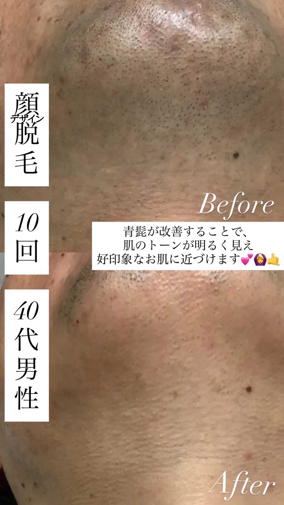 男性 デザインヒゲ脱毛 10回目のビフォーアフター