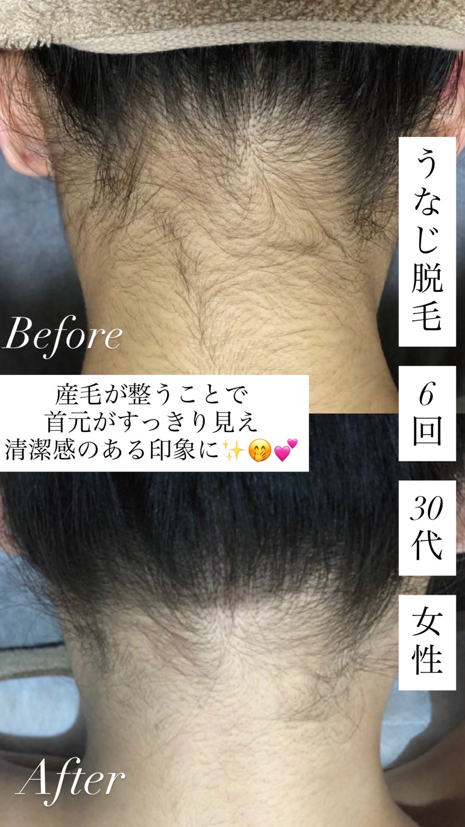 女性 うなじ脱毛 6回目のビフォーアフター