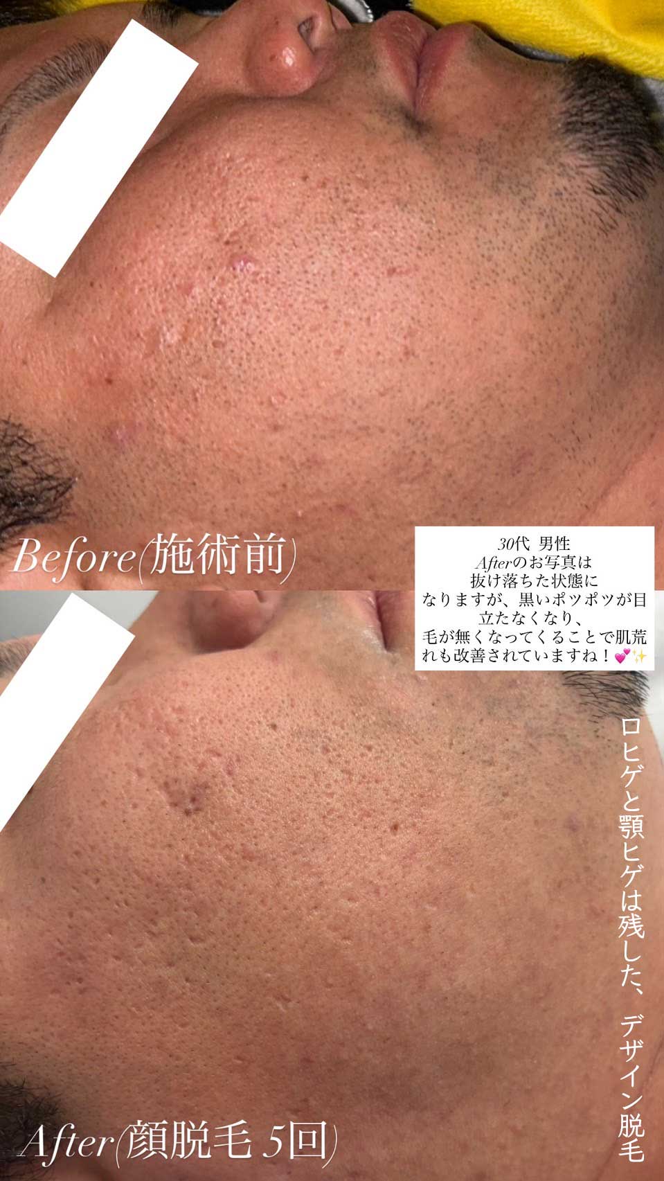 男性 顔脱毛 5回目のビフォーアフター