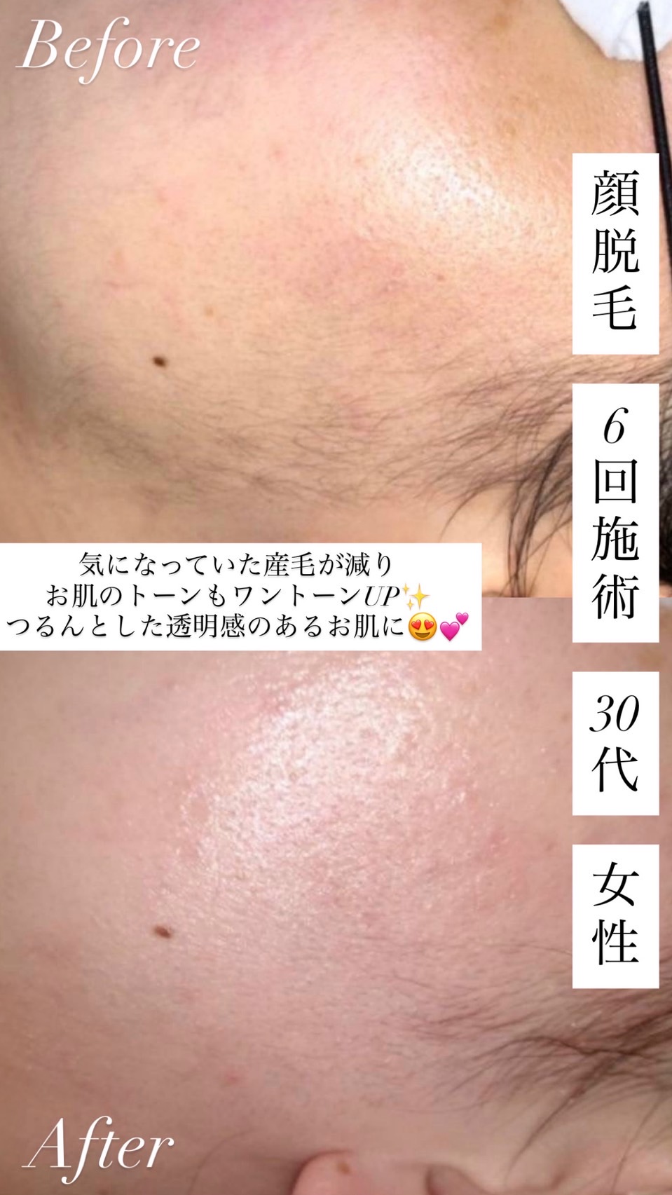 8skin脱毛 改善事例 30代女性 顔脱毛 6回 ビフォーアフター 産毛が減り肌トーンが明るい印象へ