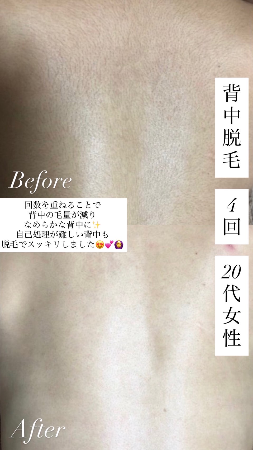 8skin脱毛 改善事例 20代女性 背中脱毛 4回 ビフォーアフター 自己処理が難しい背中もすっきり