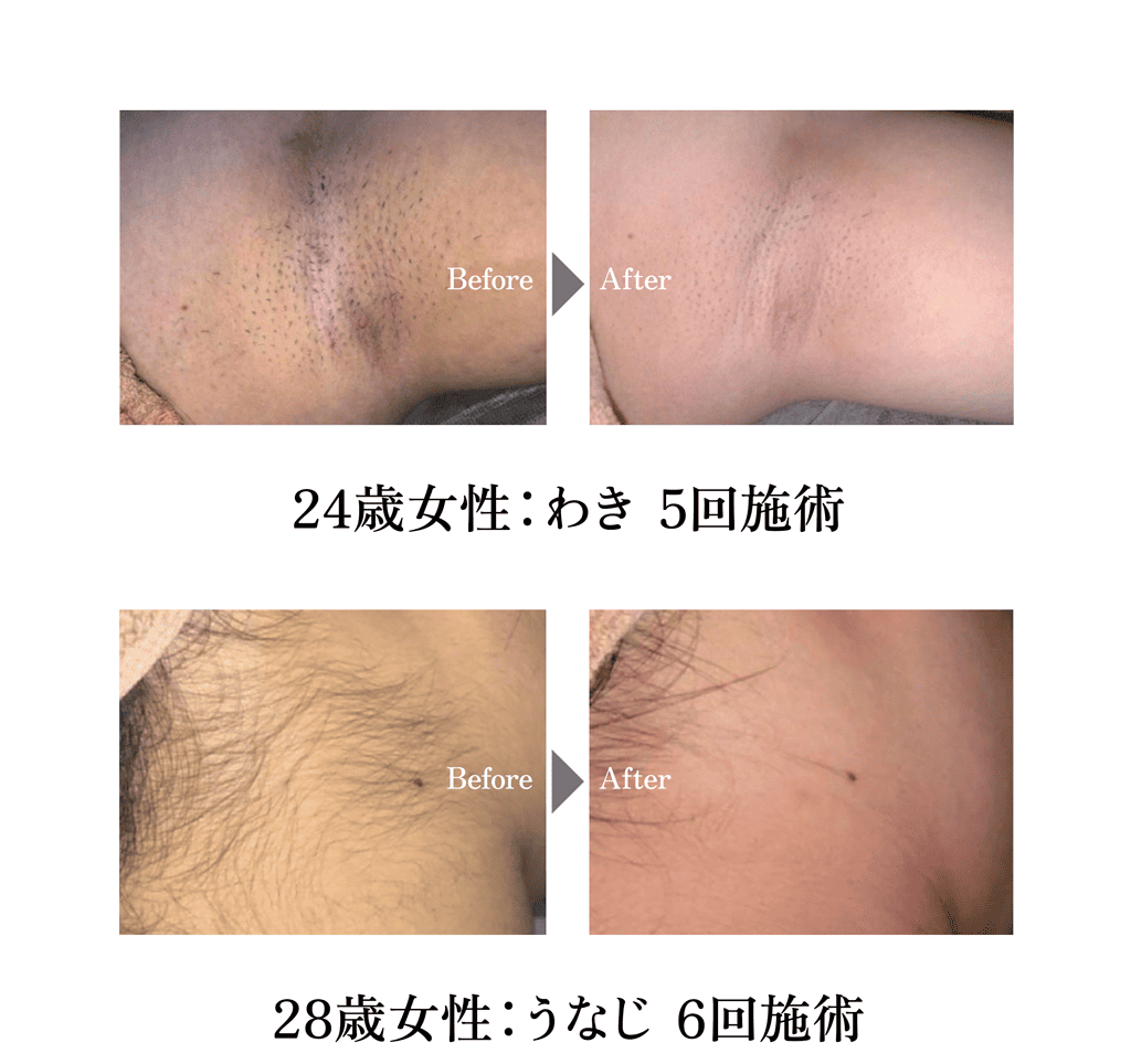 8skin脱毛 改善事例 女性脱毛 ビフォーアフター 肌見せ前の清潔感ケア