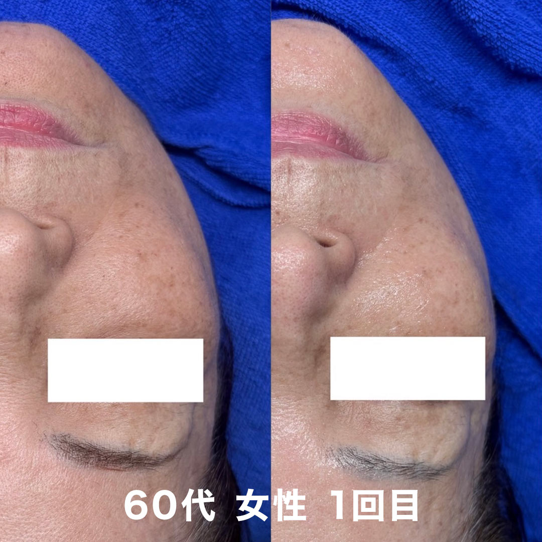 プラズマ肌質改善のビフォーアフター事例
