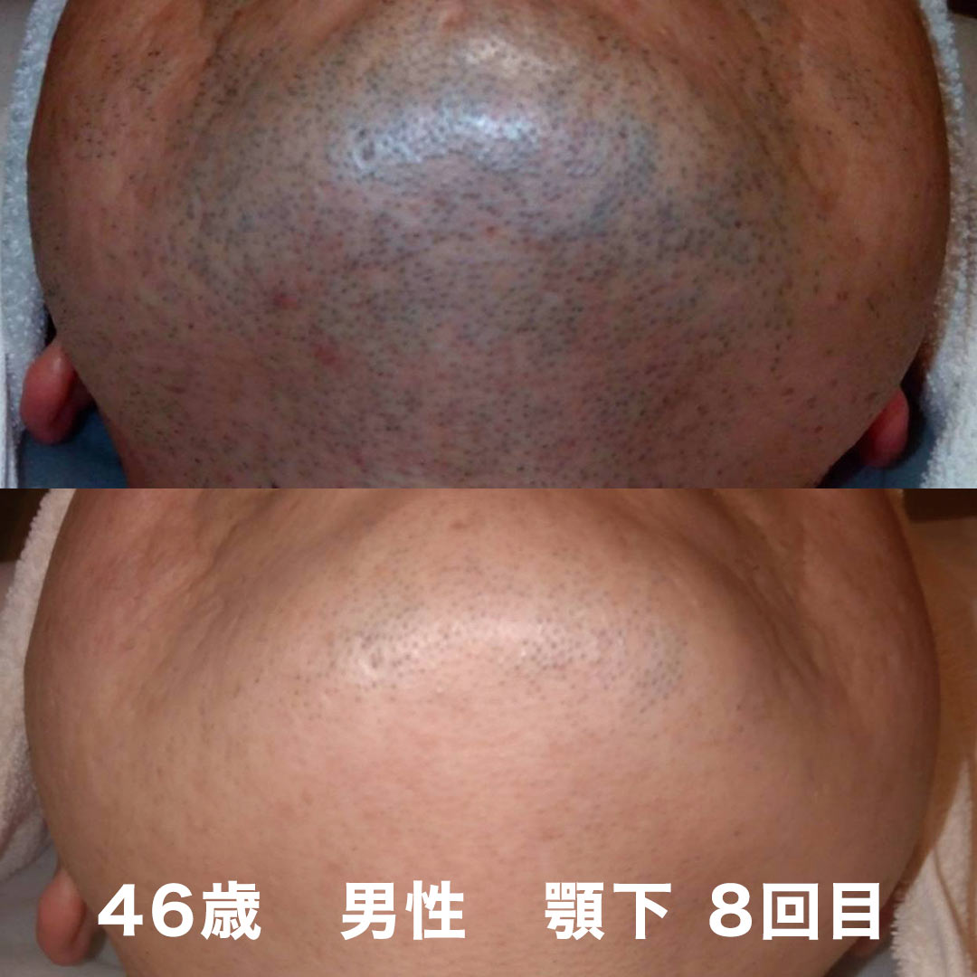 全身脱毛のビフォーアフター事例