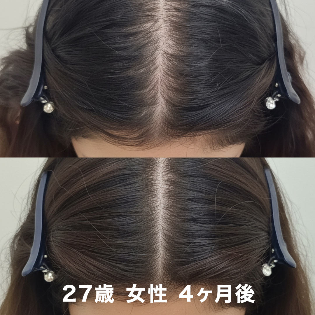育毛ケアのビフォーアフター事例